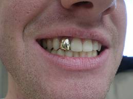 gold-tooth.jpg